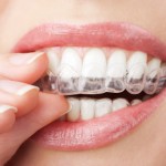 teeth with whitening tray