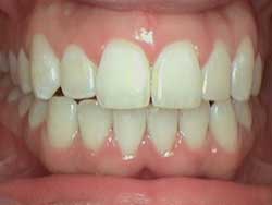 Redbank NJ Dentistry Before and After