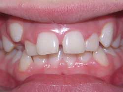 Redbank NJ Dentistry Before and After