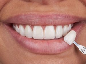 veneers