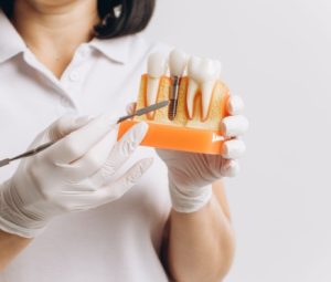 dental implants