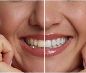 teeth whitening